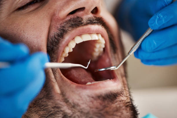 Best Cracked Tooth Emergency Dentist  in Kendale Lakes, FL